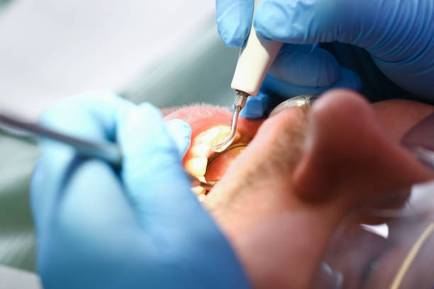 Best Emergency Dental Care for Sports Injuries in Pittsfield, IL